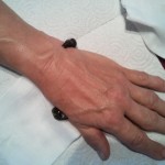 Blutegeltherapie bei Rheuma