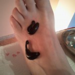 Blutegelbehandlung Arthrose am Fuß